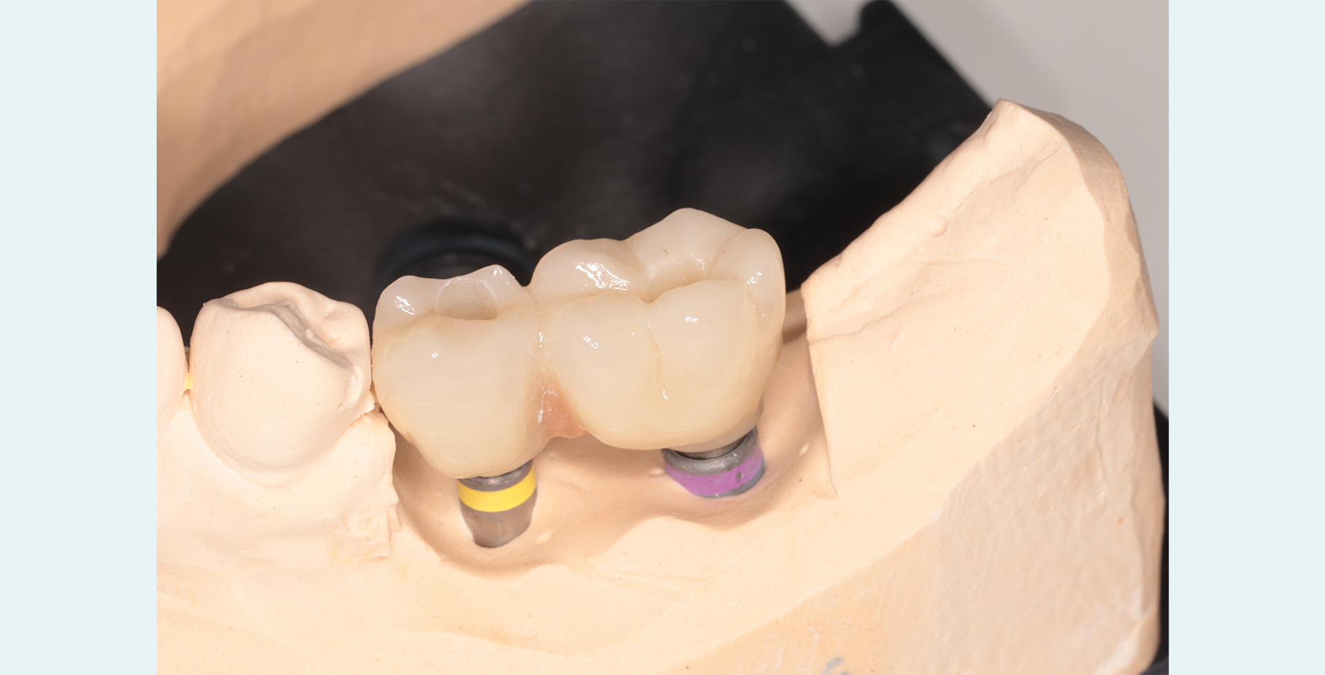 Best Dental Implants In Al Ain