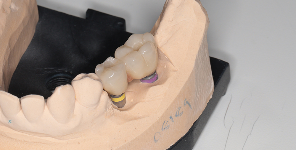 Dental Implants In Al Ain